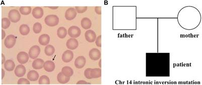 Case report: Genetic analysis of a novel intronic inversion variant in the SPTB gene associated with hereditary spherocytosis