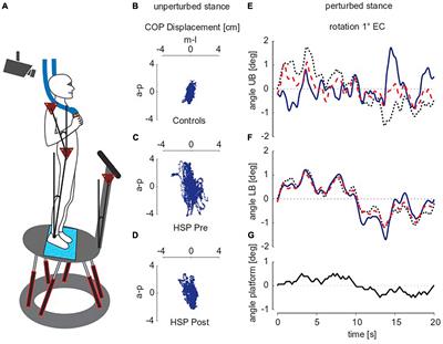 Postural control deficits due to bilateral pyramidal tract lesions exemplified by hereditary spastic paraplegia (HSP) originate from increased feedback time delay and reduced long-term error corrections