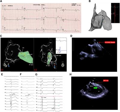 Case Report: Fluoroless implantation of left branch bundle pacing in a pregnant patient