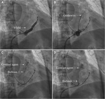 Efficacy and safety of the vein of Marshall ethanol infusion with radiofrequency catheter ablation for the treatment of persistent atrial fibrillation in elderly patients