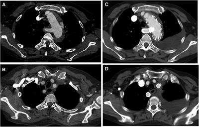 Thoracic endovascular aortic repair for type B aortic dissection with aberrant right subclavian artery: a single-center retrospective study