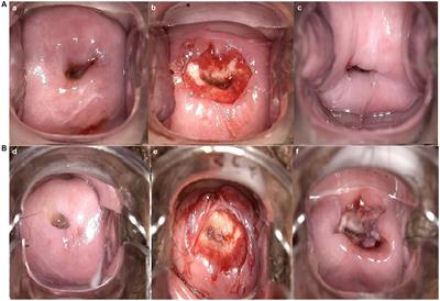 The impact of Sars-Cov-2 infection on the wound healing of cervical treatment in patients with squamous intraepithelial lesions: a retrospective cohort study