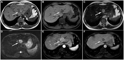 Multimodal imaging study of hepatic perivascular epithelioid cell tumors: a case report