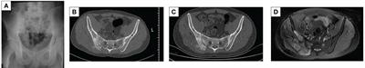 Anlotinib combined with radiotherapy and chemotherapy for recurrent pelvic osteosarcoma treatment: a case report and literature review