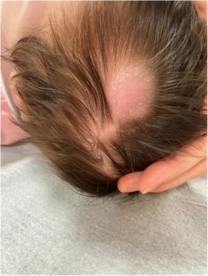 A single scalp nodule as the first presentation of acute lymphoblastic leukemia (KMT2A::MLLT3) in a healthy-appearing infant: a case report