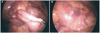 Case Report: Acute abdomen and large mesenteric mass as another face of multisystem inflammatory syndrome in an adolescent child: measure twice, act once!