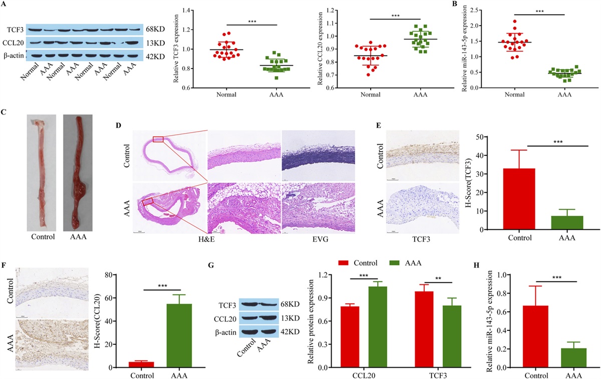 Transcription Factor TCF3 Promotes Macrophage-Mediated Inflammation and MMP Secretion in Abdominal Aortic Aneurysm by Regulating miR-143-5p/CCL20