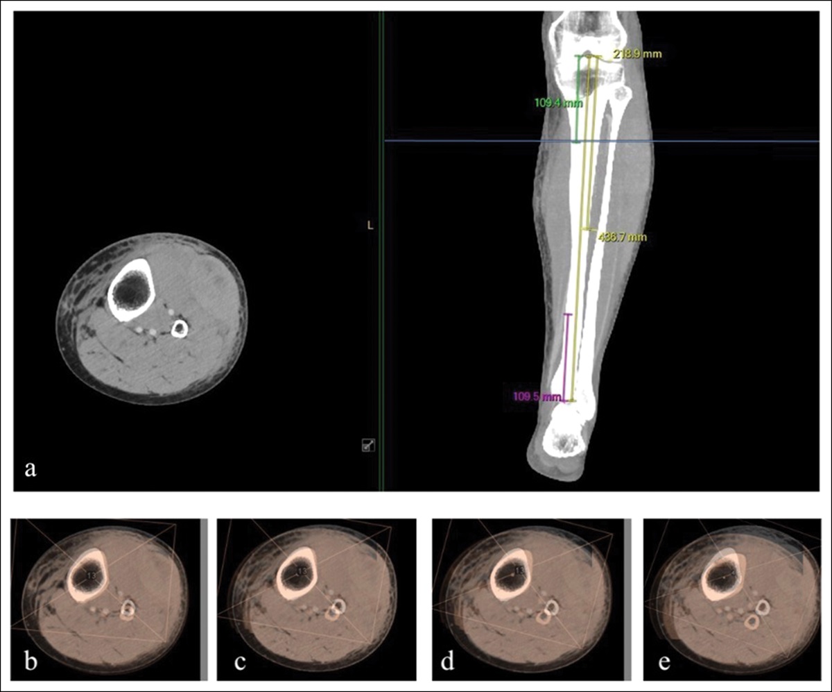 Does Fibular Displacement Predict Tibial Malrotation in Simulated Tibia-Fibula Fractures