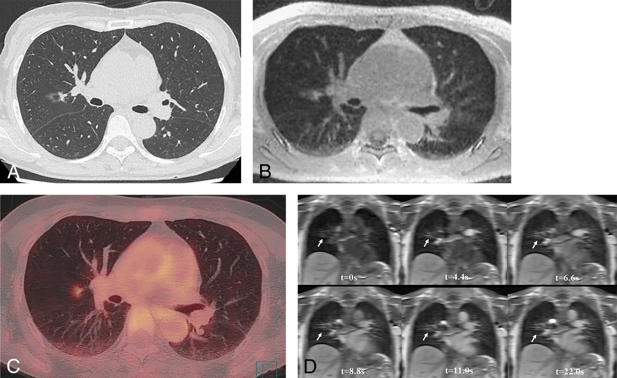 Lung Magnetic Resonance Imaging: Technical Advancements and Clinical Applications