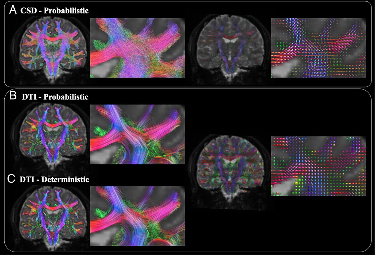 Advancements in Diffusion MRI Tractography for Neurosurgery