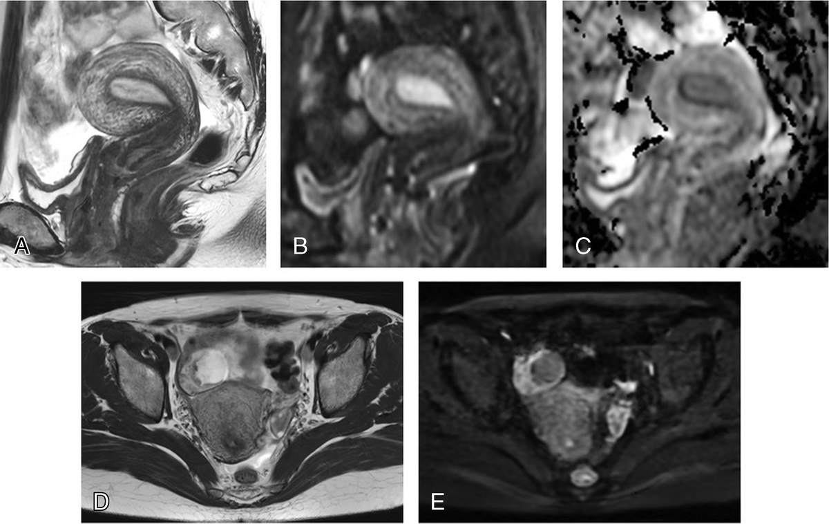 Clinical Utility of Diffusion-Weighted Imaging in Gynecological Imaging: Revisited