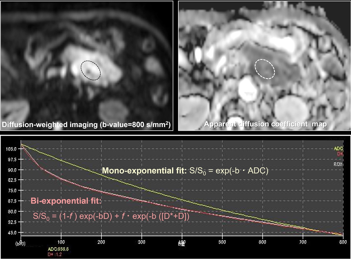 Quantitative Magnetic Resonance Imaging for the Pancreas: Current Status