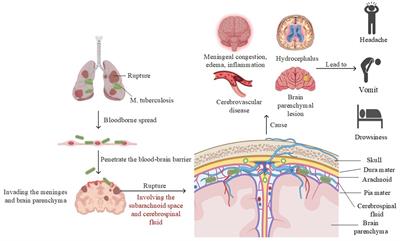 MRI advances in the imaging diagnosis of tuberculous meningitis: opportunities and innovations