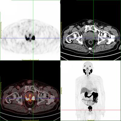 Case report: 177Lu DOTA-TATE: a new scheme for the treatment of prostate neuroendocrine cancer