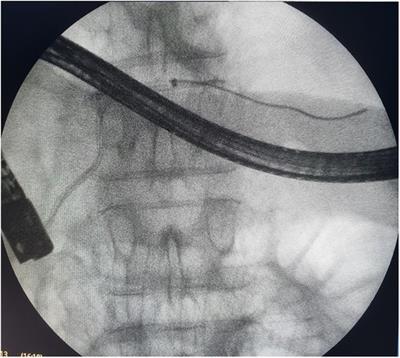 Endoscopic transpapillary stent placement in patients with necrotizing pancreatitis and disconnected main pancreatic duct syndrome