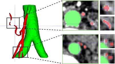 PE-Net: a parallel framework for 3D inferior mesenteric artery segmentation