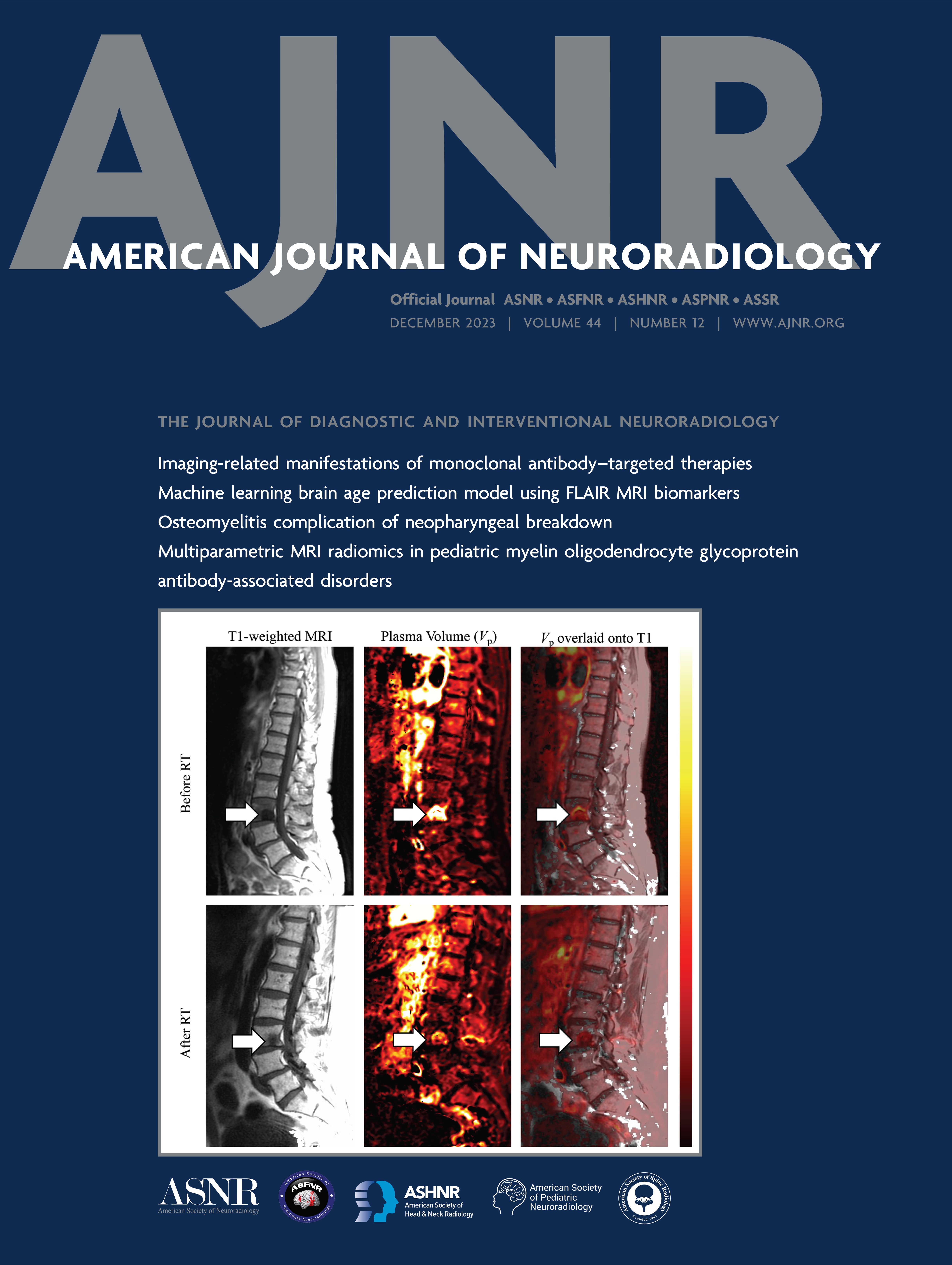 Brain Abnormalities in Becker Muscular Dystrophy: Evaluation by Voxel-Based DTI and Morphometric Analysis [NEURODEGENERATIVE DISORDER IMAGING]