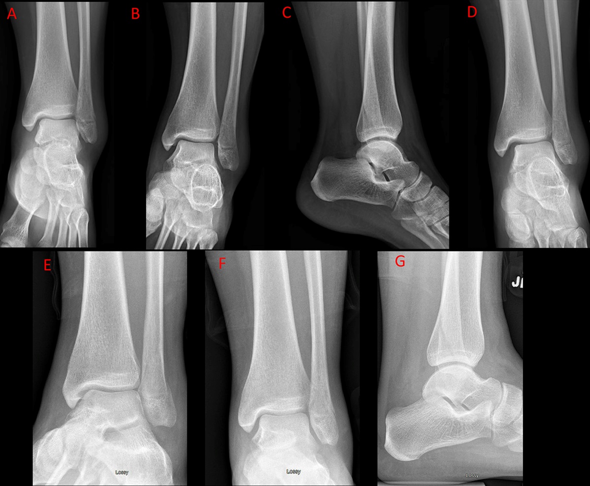 Successful Outcomes With Nonoperative Treatment and Immediate Weightbearing Despite Stress-Positive Radiographs in Isolated Distal Fibula (OTA/AO 44B) Fractures