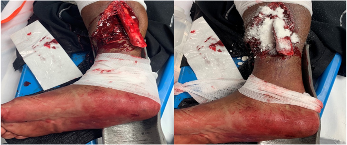 The Effect of Topical Antibiotic Powder Application in the Emergency Department on Deep Fracture–Related Infection in Type III Open Lower Extremity Fractures