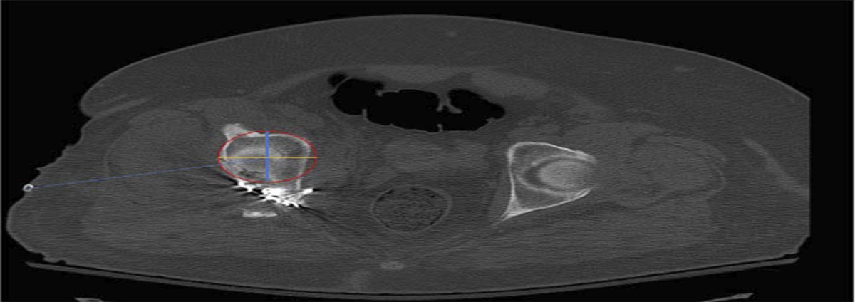 Opportunistic Use of Computed Tomography to Determine Muscle–Adipose Ratio Reliably Predicts Wound Complications After Kocher-Langenbeck Surgical Exposure of the Acetabulum