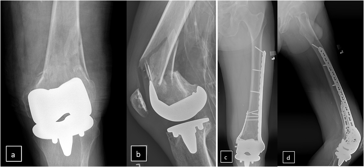 Dual Plate Fixation of Periprosthetic Distal Femur Fractures