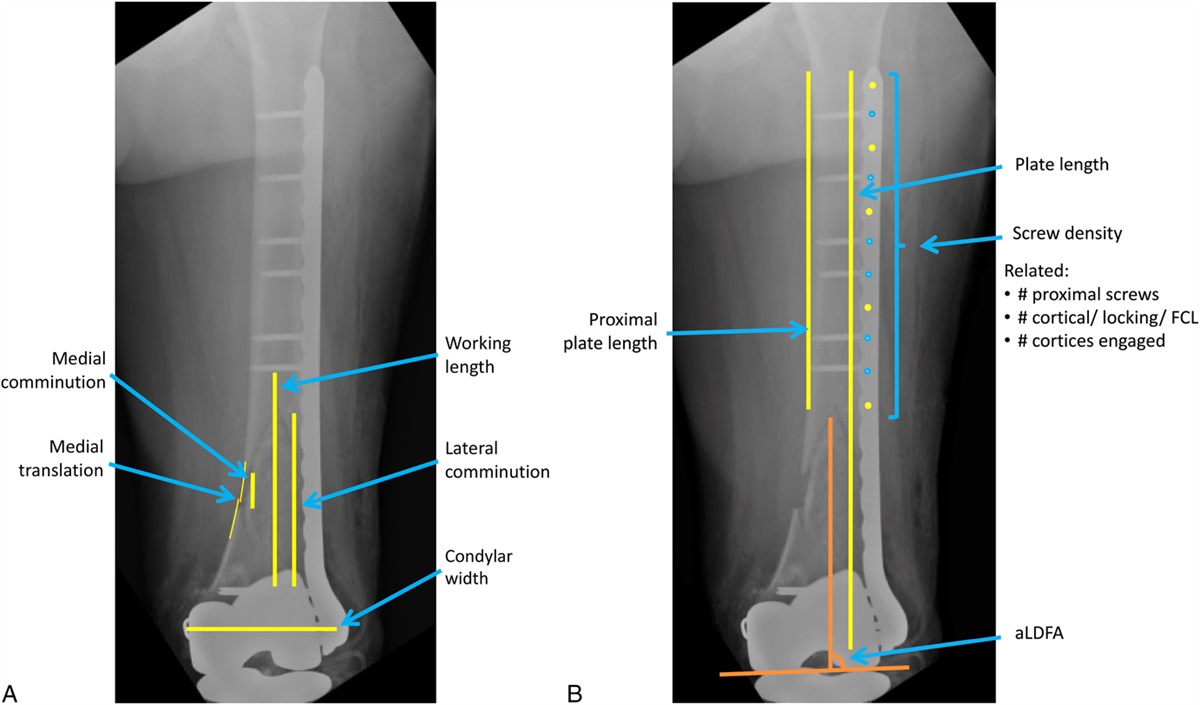 Technical Factors Contributing to Nonunion in Supracondylar Distal Femur Fractures Treated With Lateral Locked Plating: A Risk-Stratified Analysis