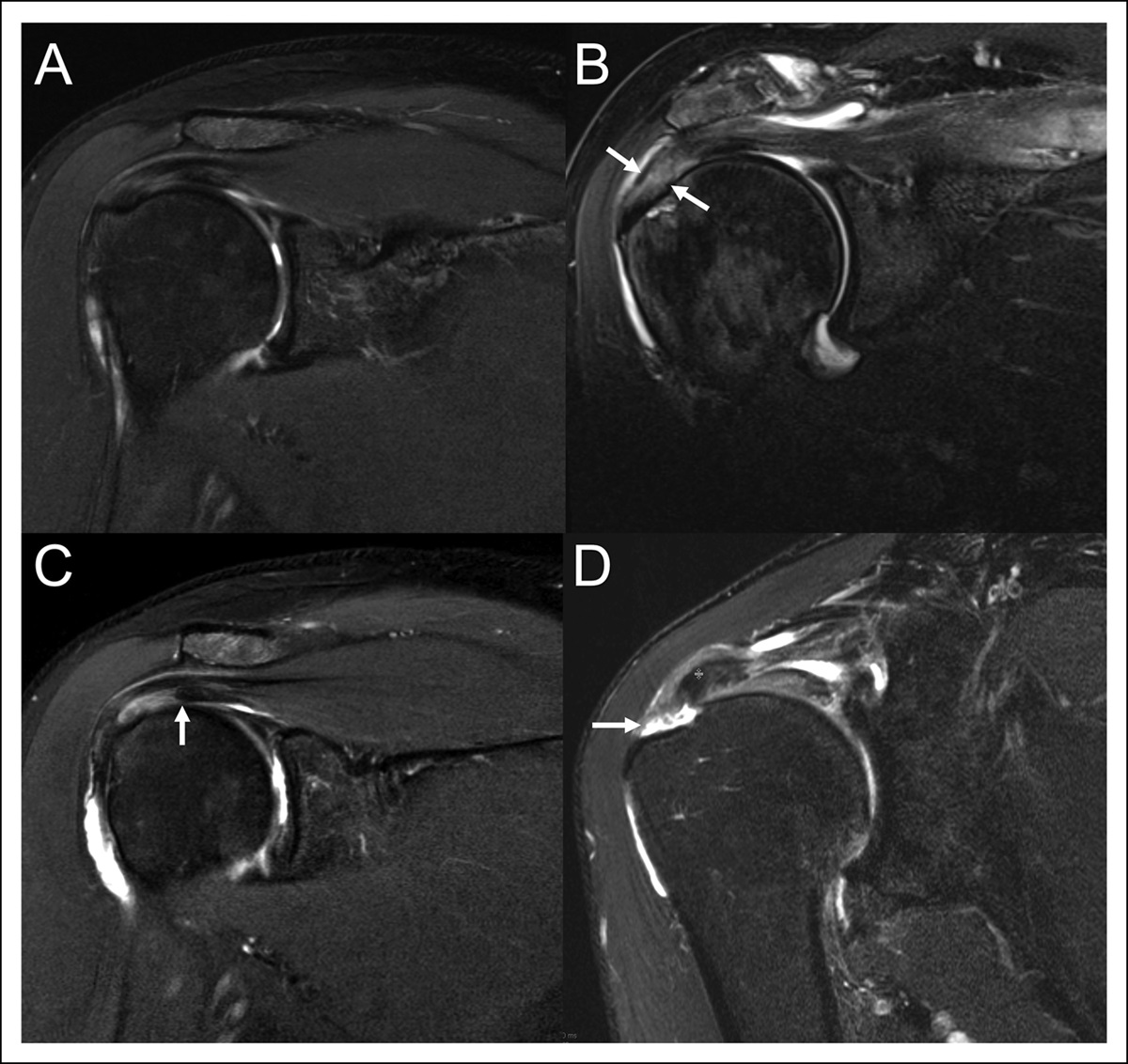 Magnetic Resonance Imaging of the Shoulder: Interpretation of Common Orthopaedic Injuries