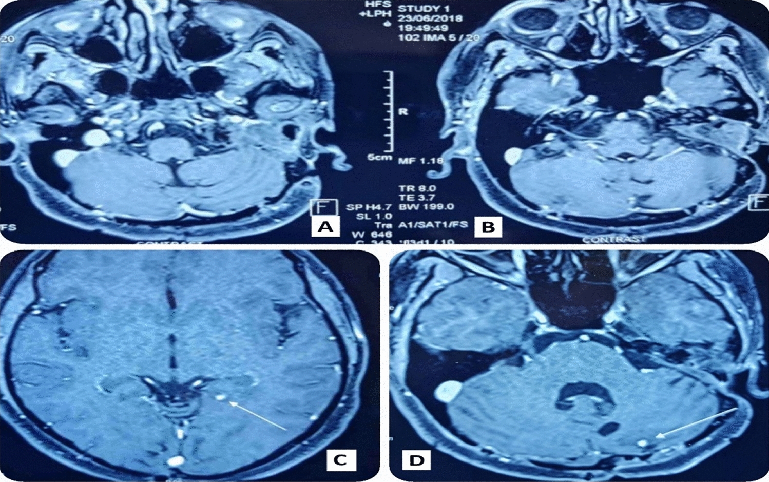 Management of Pregnancy in a Case of Endolymphatic Sac Tumour as a Part of Von Hippel–Lindau Syndrome Complex: A Case Report and Review of Literature