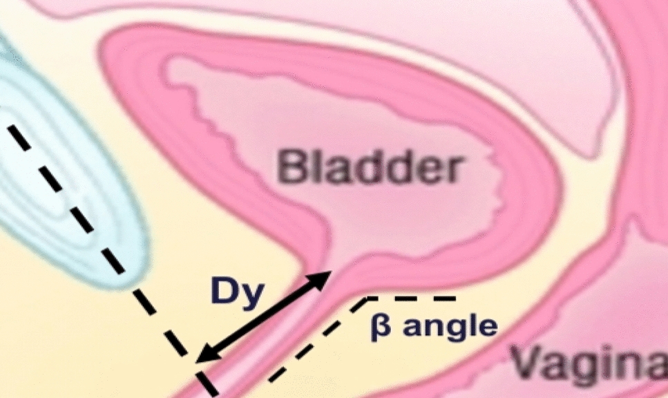 Transperineal Ultrasound Evaluation of Bladder Parameters in Patients with Apical Prolapse Undergoing Lateral Suspension or Sacropexy