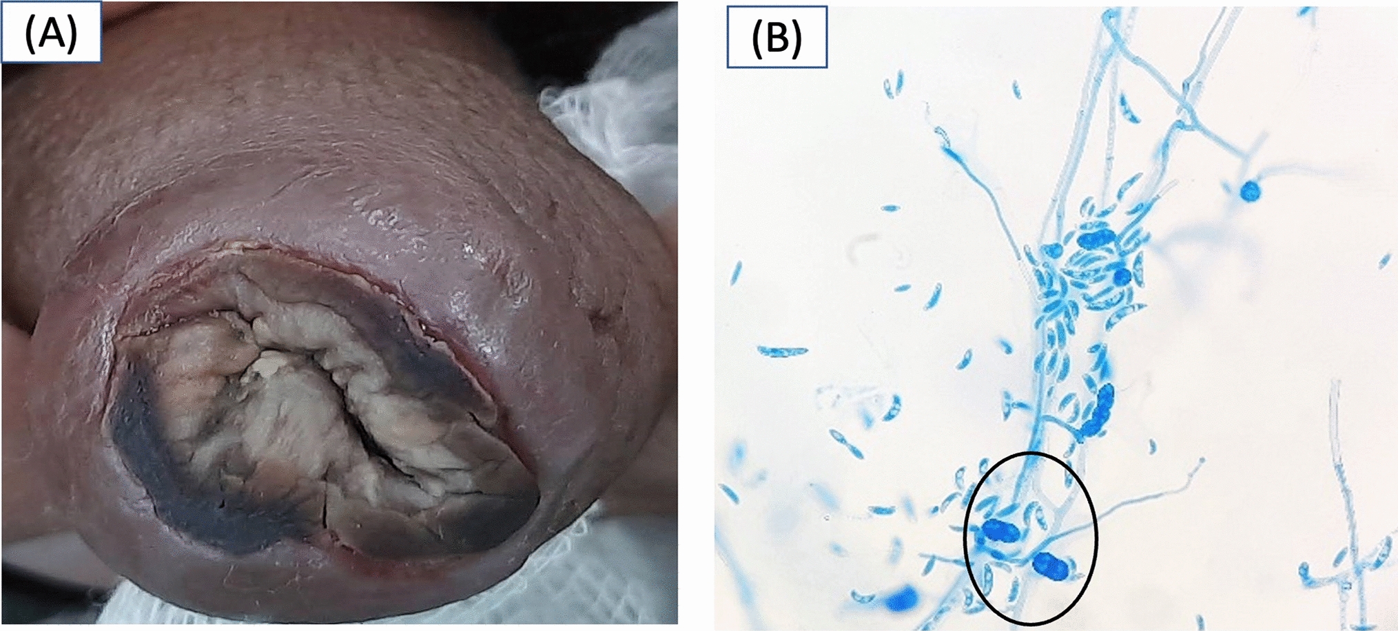 Fusarium infection on the penile prepuce in an allogeneic transplant recipient