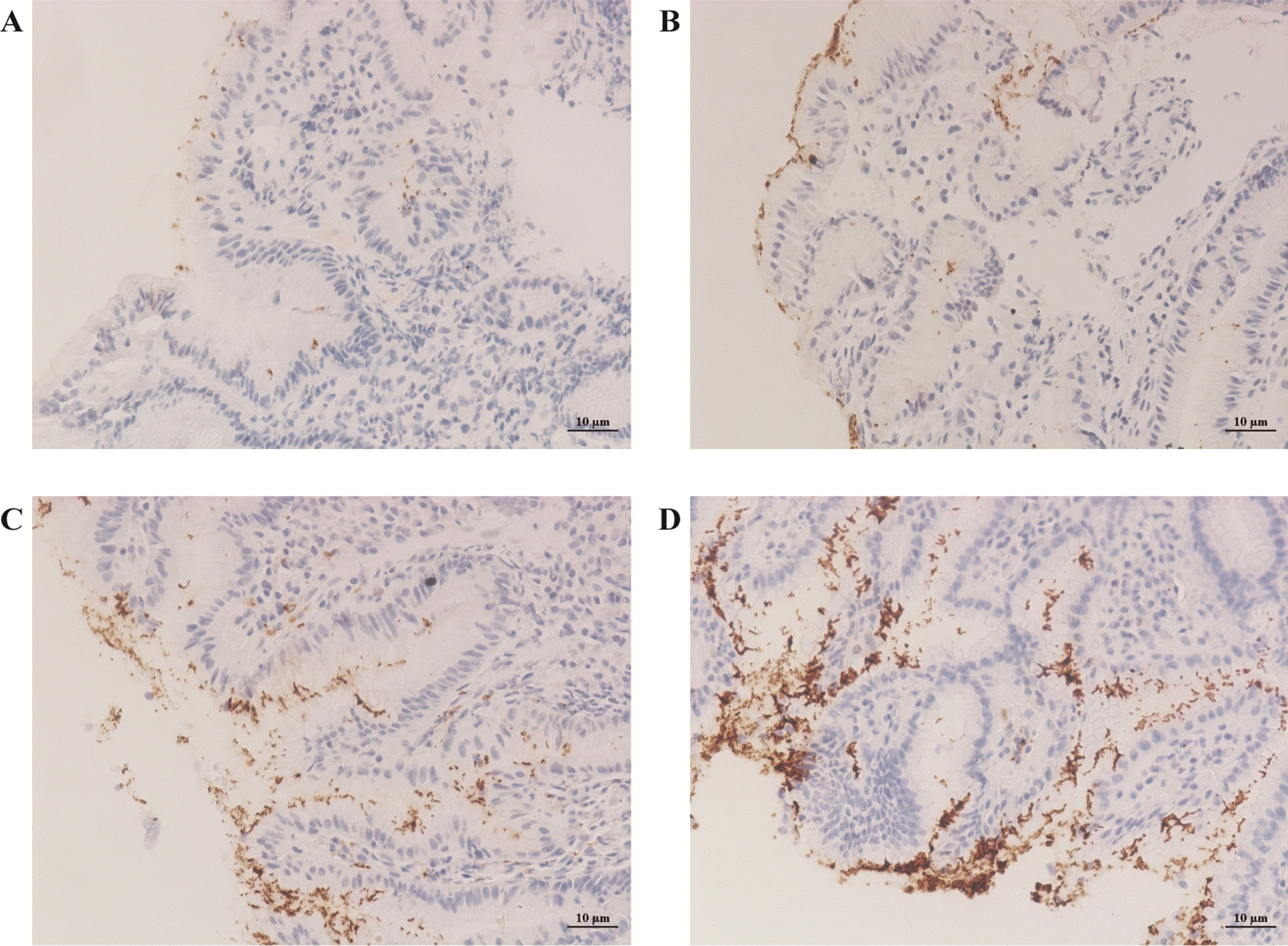 Impact of Helicobacter pylori colonization density and depth on gastritis severity