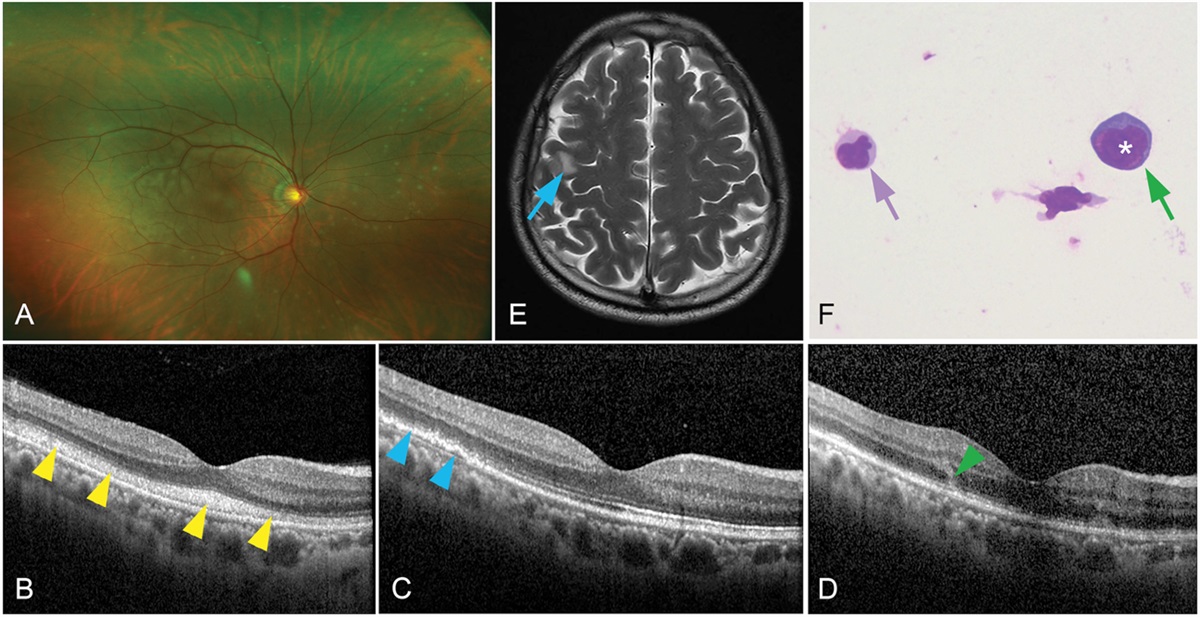 Cloudy Vitelliform Submaculopathy as an Early Sign of Primary Vitreoretinal Lymphoma