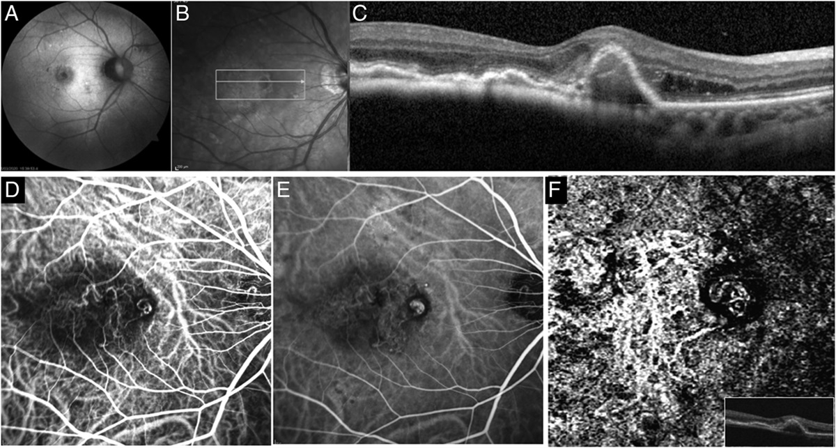POLYPOIDAL LESIONS ASSOCIATED WITH CHOROIDAL NEVI
