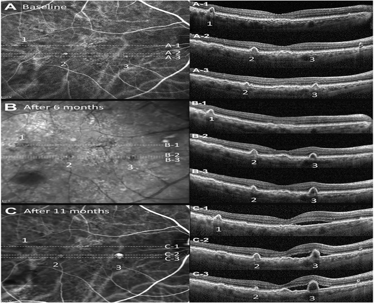 RISK OF EXUDATION IN EYES WITH NONEXUDATIVE POLYPOIDAL CHOROIDAL VASCULOPATHY
