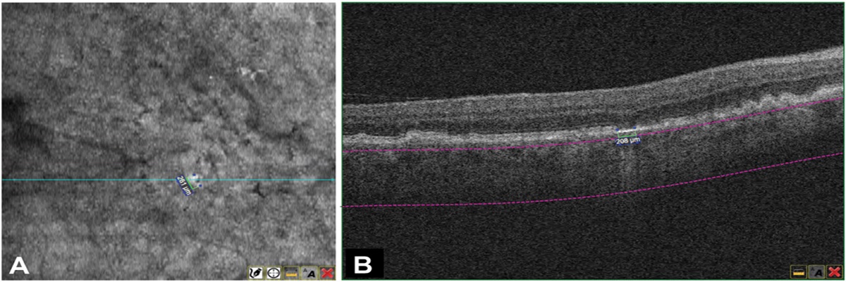 PREVALENCE AND PERSISTENCE OF HYPERTRANSMISSION DEFECTS OF VARIOUS SIZES IN EYES WITH INTERMEDIATE AGE-RELATED MACULAR DEGENERATION
