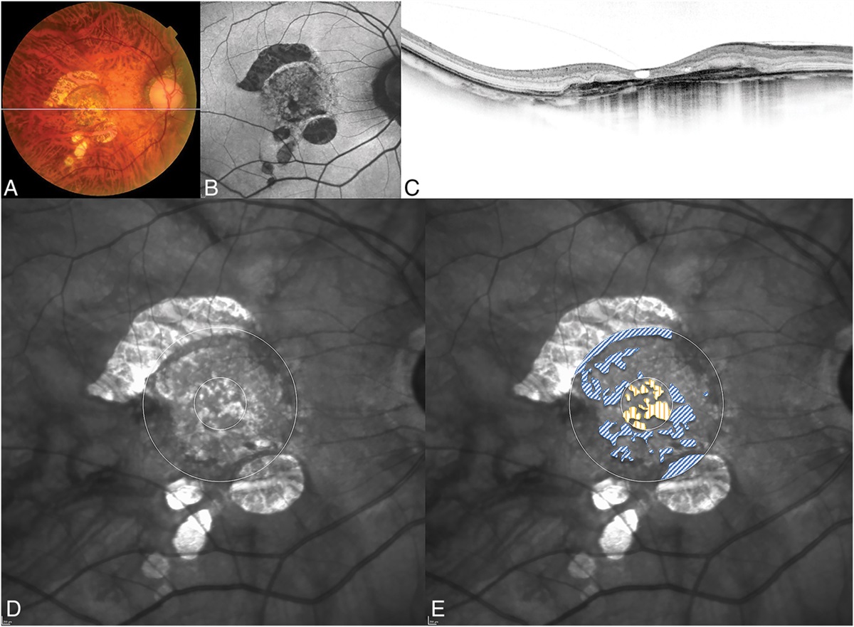 MACULAR CHORIORETINAL ATROPHY AND VISUAL OUTCOMES IN RANIBIZUMAB- OR AFLIBERCEPT-TREATED MYOPIC CHOROIDAL NEOVASCULARIZATION