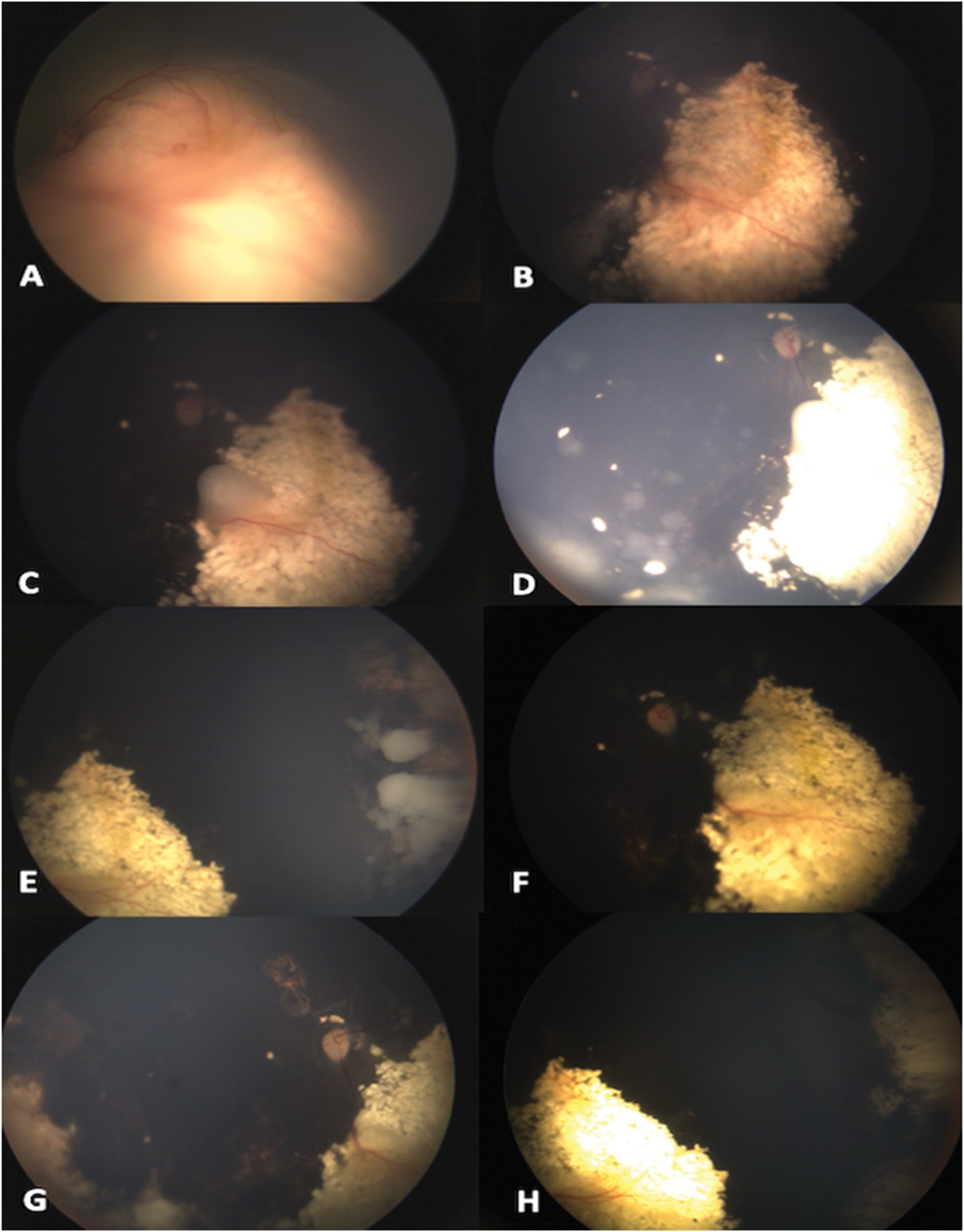 SECONDARY SALVAGE INTRAVENOUS CHEMOTHERAPY FOR REFRACTORY/RECURRENT RETINOBLASTOMA: A Study of 41 Eyes