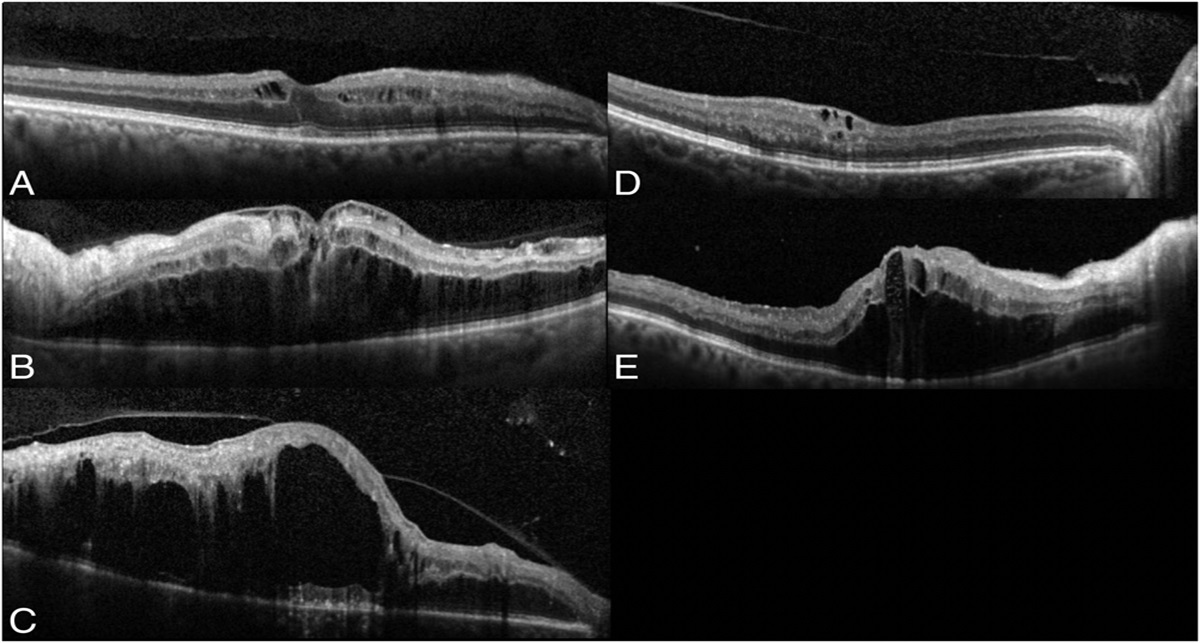 IMPLICATIONS OF COMPLETE POSTERIOR VITREOUS DETACHMENT IN EYES WITH CENTRAL RETINAL VEIN OCCLUSION