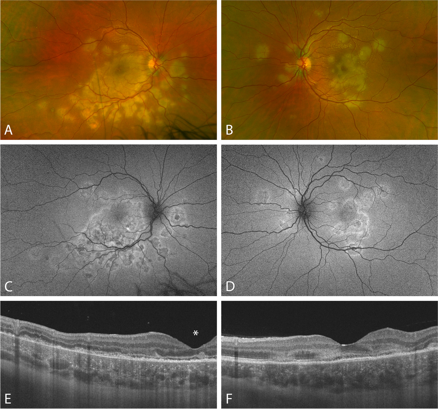 Long-term follow-up of a bilateral acute posterior multifocal placoid pigment epitheliopathy following COVID-19 infection: a case report