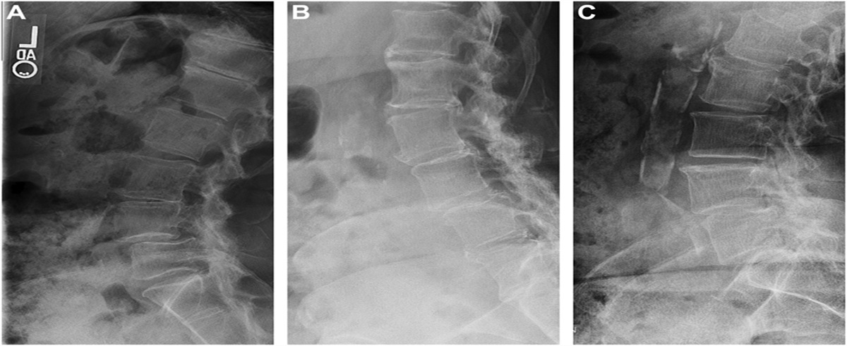 Association of abdominal aortic calcification and lower back pain in patients with degenerative spondylolisthesis