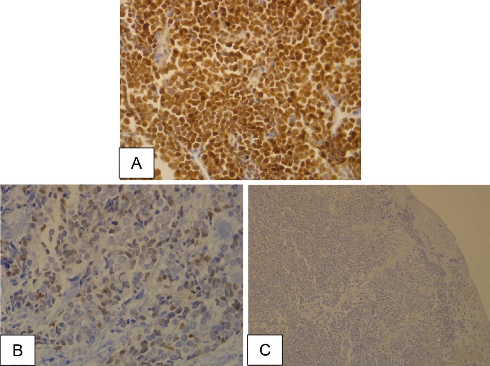 The prognostic role of PD-L1 expression and the presence of polyomavirus in Merkel cell carcinoma cases