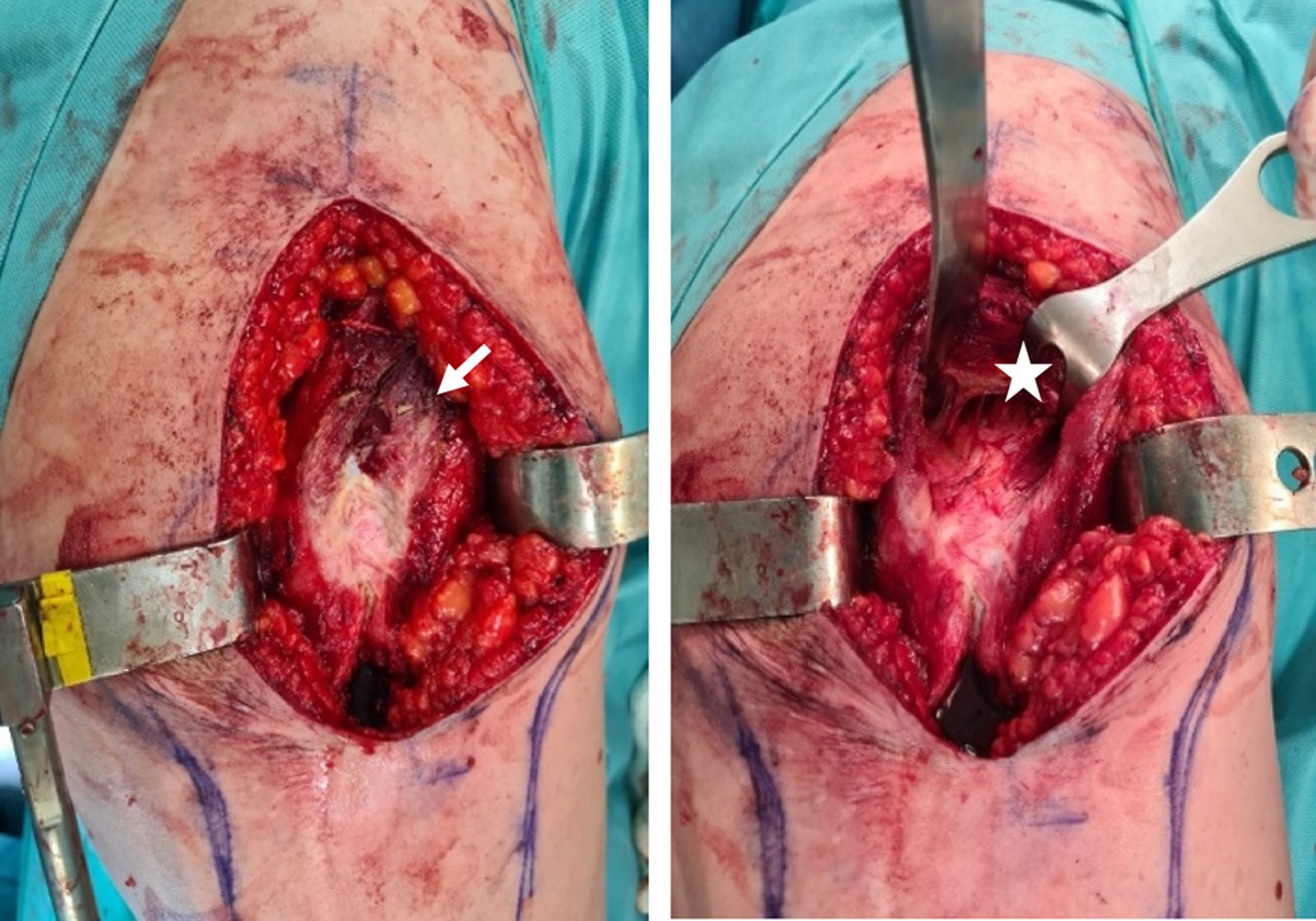 Reference suture of gluteus minimus muscle: a modification of the lateral approach in total hip arthroplasty
