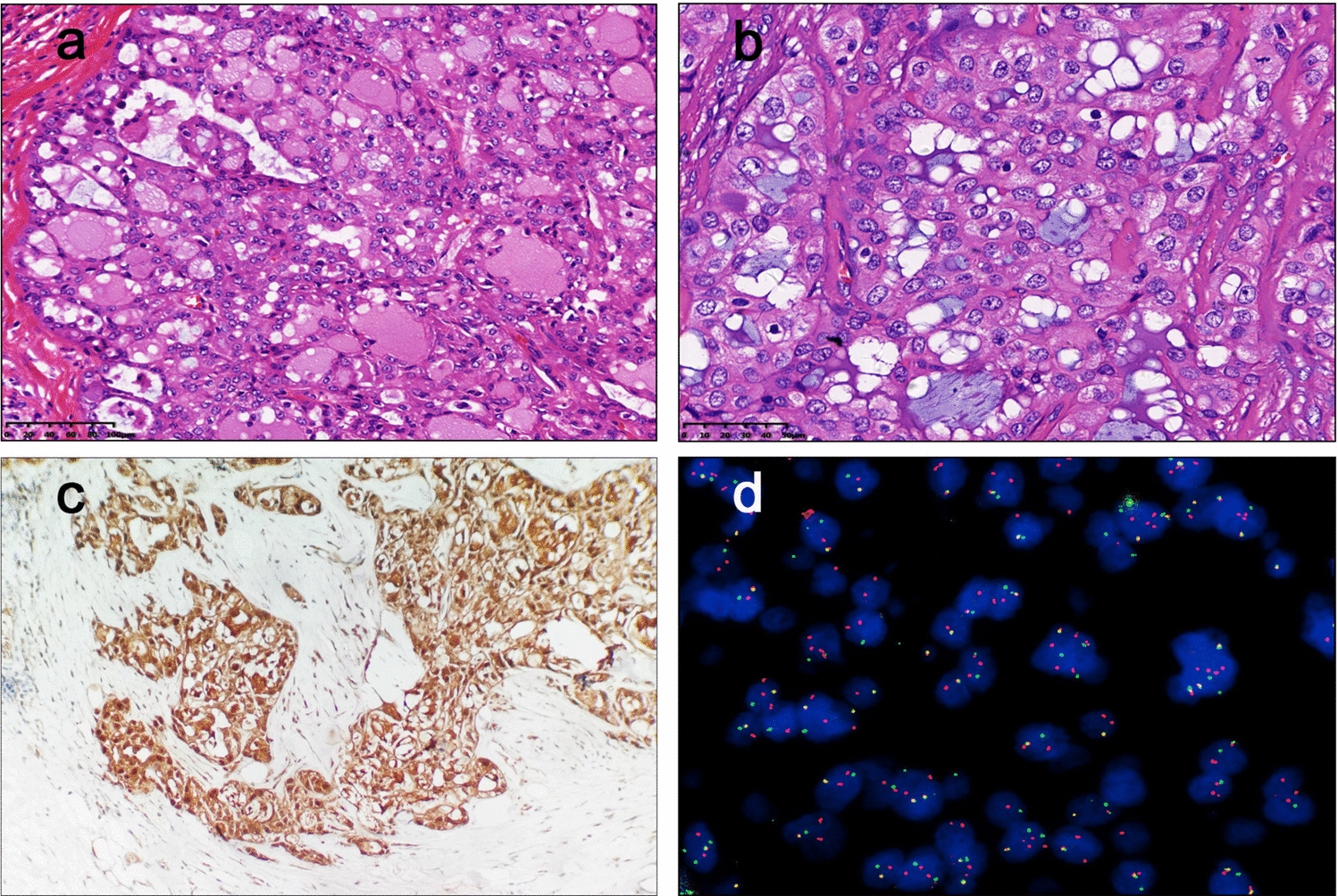 Secretory breast carcinoma: clinicopathological features and prognosis of 52 patients