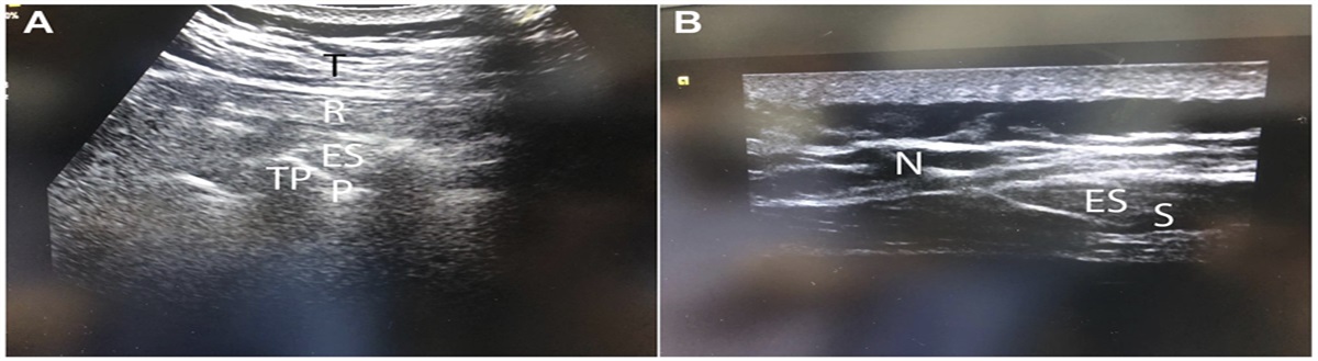 Ultrasound-guided continuous erector spinae plane block vs continuous thoracic epidural analgesia for the management of acute and chronic postthoracotomy pain: a randomized, controlled,double-blind trial