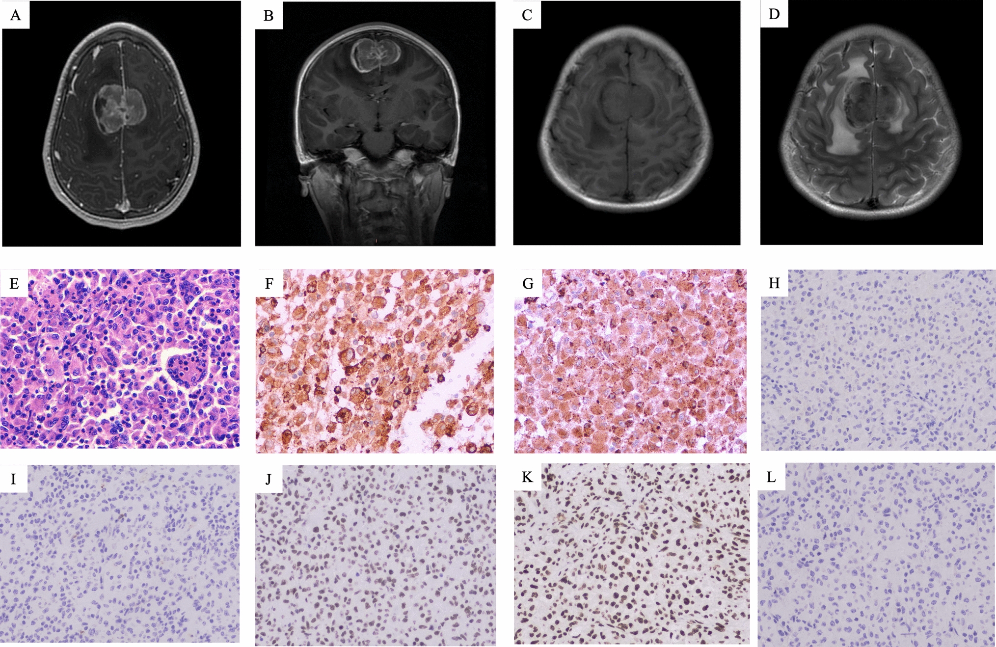 A rare case of primary central nervous system histiocytic sarcoma harboring a novel ARHGAP45::BRAF fusion: a case report and literature review