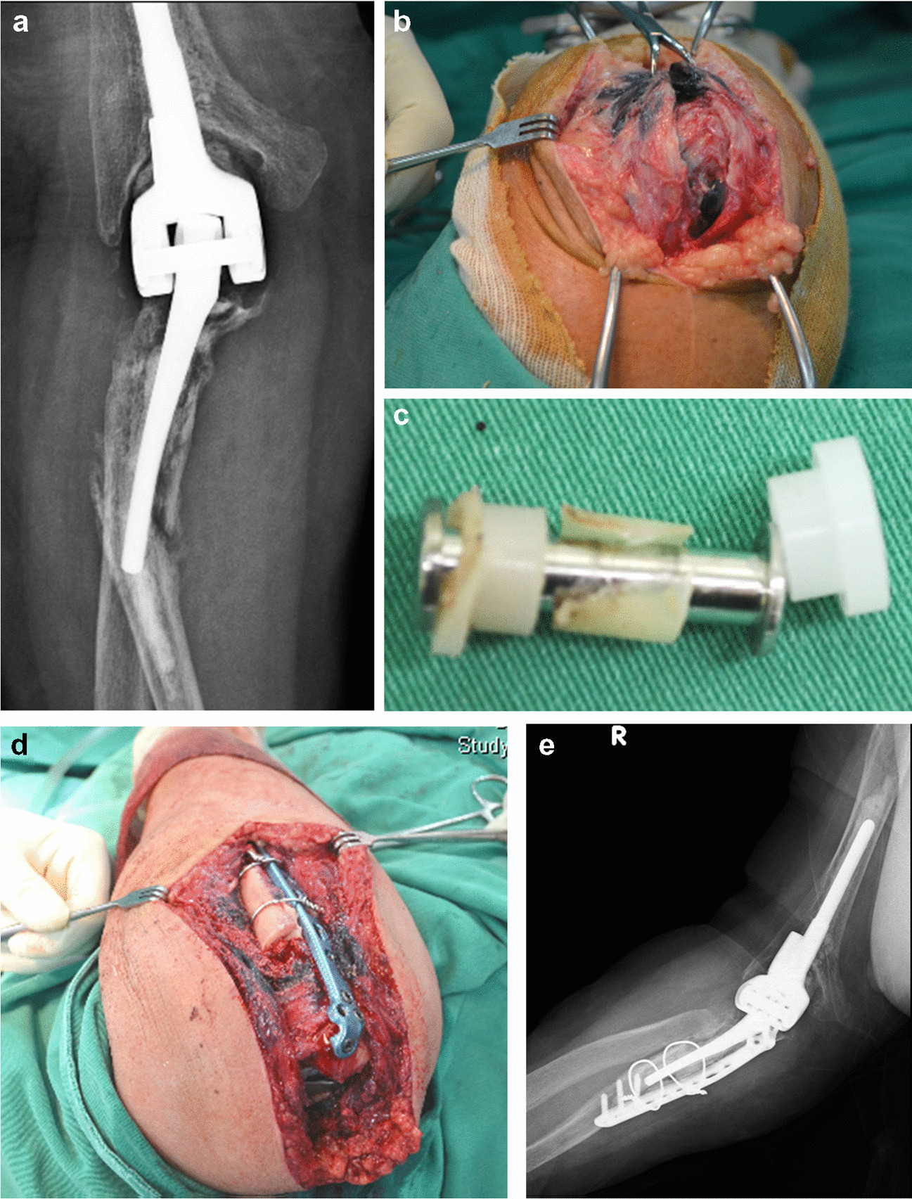 Failure of the linkage mechanism in a semi-constrained total elbow arthroplasty is a rare and unpredictable event: a review of seven cases