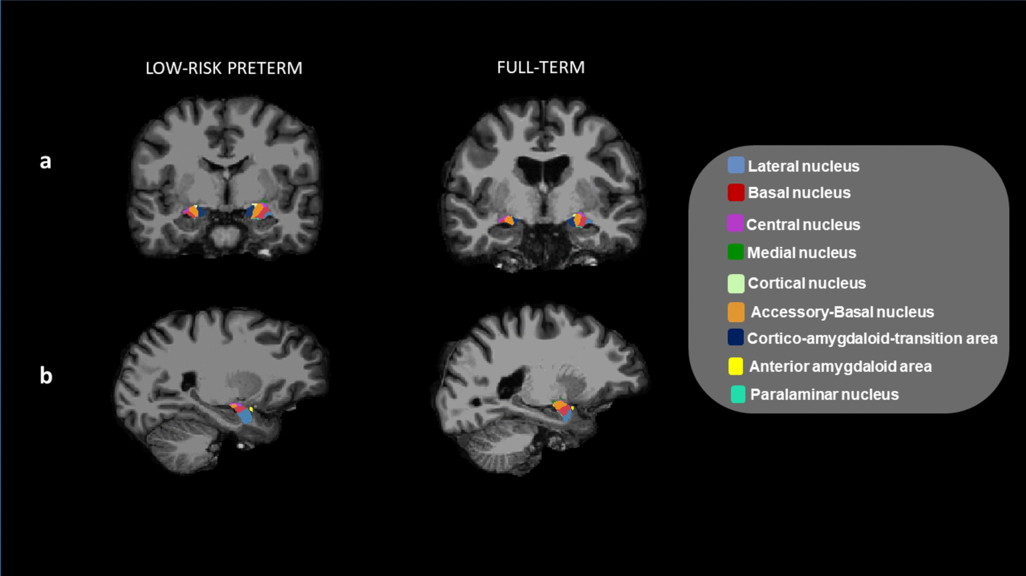 Amygdala structure and function and its associations with social-emotional outcomes in a low-risk preterm sample