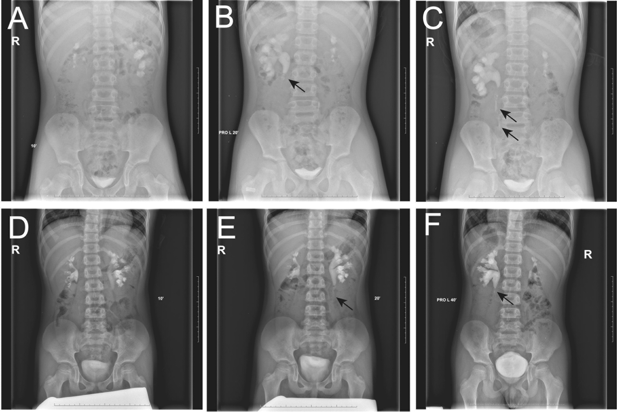 Ureteropelvic junction obstruction with polyps in children: clinical manifestations and supranormal preoperative differential renal function