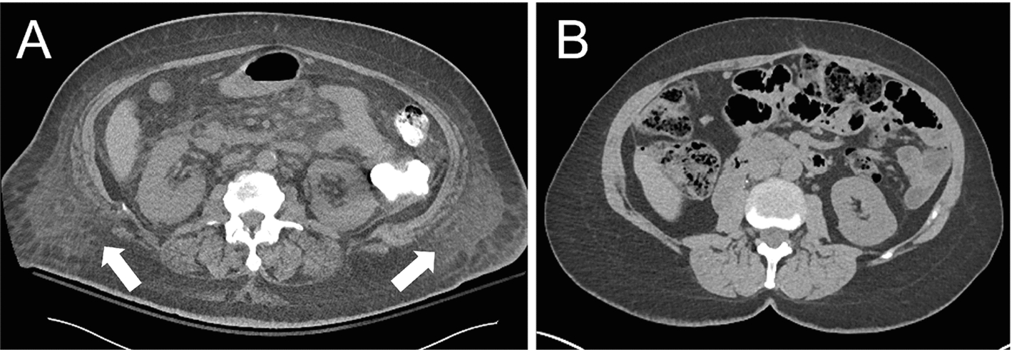Improved subcutaneous edema segmentation on abdominal CT using a generated adipose tissue density prior