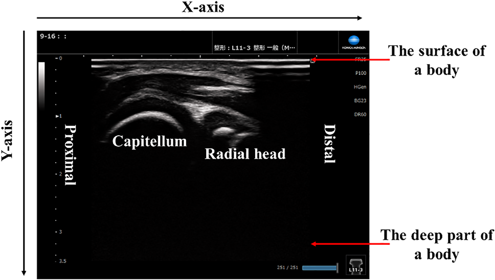 Deep learning-based osteochondritis dissecans detection in ultrasound images with humeral capitellum localization